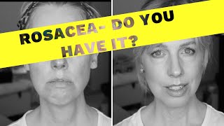 HOW TO KNOW IF YOU HAVE ROSACEA ⛔️ My 20 Year Journey from diagnosis to present day [upl. by Zilef]