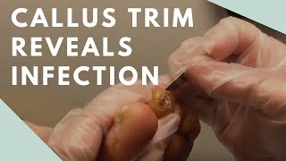 Callus Trim Reveals Infection [upl. by Grobe]