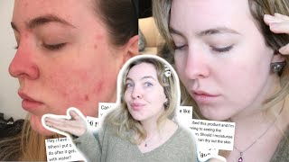 MY ACNE JOURNEY 1 YEAR LATER HOW DUAC SAVED MY SKIN  ANSWERING YOUR QUESTIONS [upl. by Cramer]