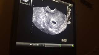 Pregnancy ultrasound 5 weeks and 5 days [upl. by Tiny]