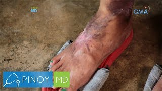 Pinoy MD What is Statis Dermatitis [upl. by Lipscomb678]