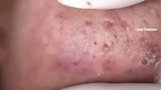 111  Acne Treatment Huong Beauty  The best  Weekend relax [upl. by Robinet]