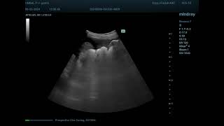 Peritoneal carcinomatosis [upl. by Nov]