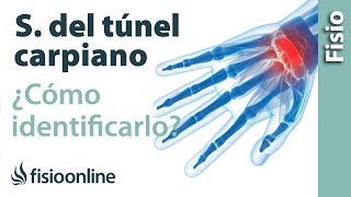 Cómo saber si tienes el síndrome del túnel carpiano [upl. by Niel401]