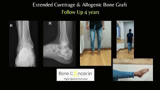 Treatment for Bone Cyst Aneurysmal Calcaneus in AdultCurettage and Bone Grafting Dr Srimanth BS [upl. by Theron]