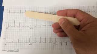 pericarditis on EKG [upl. by Alamaj]