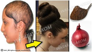 How to Grow Long Thicken Hair with Onion  Worlds Best Remedy for Hair Growth [upl. by Urata32]