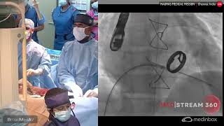 Mitral TTK Chithra Paravalvular Leak Closure [upl. by Shelia]