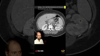 SINAL DO NEFROGRAMA ESTRIADO  Sinal Radiológico em 1 Minuto [upl. by Nallek177]