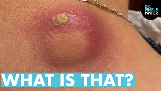 WHAT IS THAT Dr Lee Pops Satisfying Back Cyst  Dr Pimple Popper Reacts [upl. by Hodgkinson464]