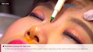 IFAAS Exclusive Training Video Ultra V Hiko Nose Thread Lifting by Dr HanJin Kwon [upl. by Lati]