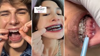 Orthodontist Reacts To Painful Dental TikToks [upl. by Trixy]