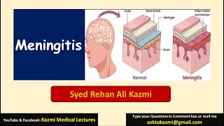 Meningitis  Neurology  Pediatric Review  KML [upl. by Antonino]