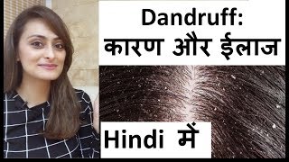 डैंड्रफ के कारण और ईलाज  हिंदी में। dandruff causes amp treatment डॉ आँचल पन्त [upl. by Enyahs796]