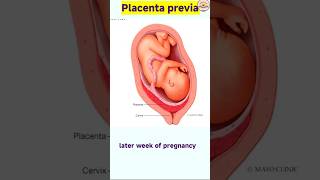 Placenta previa kya hota hai  Type risk factor  symptoms  placenta previa nursing notes [upl. by Brantley]