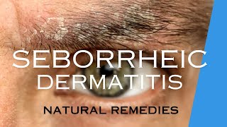 TREAT SEBORRHEIC DERMATITIS with NATURAL REMEDIES [upl. by Dlared]