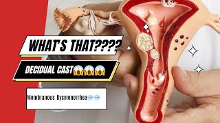 Decidual Cast  Period  flesh in your period menses women periods [upl. by Trebmer894]