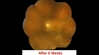 Old RETINAL Detachment with Subretinal fibrous band in Pseudophakic case II Dr Billal Hossain [upl. by Endys]