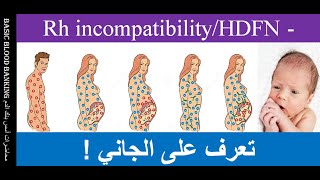 Lecture 73 HDFN  Rh incompatibility [upl. by Adnyl130]