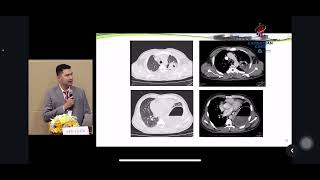 Management of lung abscess [upl. by Gardiner]