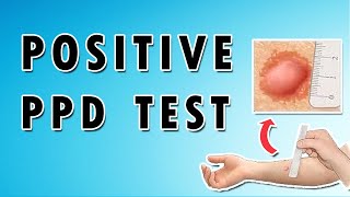 Positive PPD Test [upl. by Siloam]