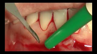 10 Bilaminar technique on single incisor in the lower jaw [upl. by Dranek]