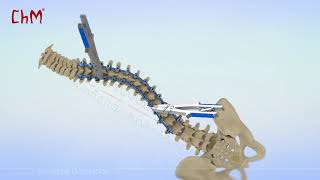 CHARSPINE2 VD  Vertebral Derotation [upl. by Eednar]