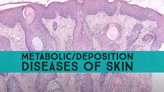 MetabolicDeposition Diseases of Skin amp Mimics Board Review for Dermpath Dermatology Pathology [upl. by Eidak]