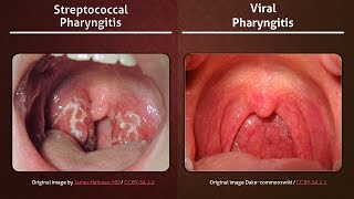 Streptococcal vs Viral Pharyngitis [upl. by Nnylirak]