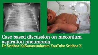 Meconium aspiration pneumonia Neonatal MAS Dr Sridhar K [upl. by Nicky]