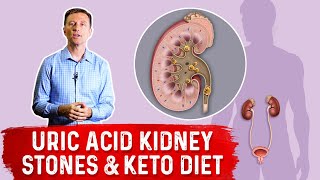 Uric Acid Kidney Stones amp Keto Diet – Dr Berg [upl. by Brantley776]