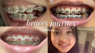 Braces Overbite Time lapse with extractions [upl. by Nawud]