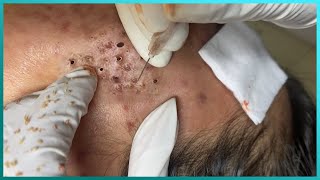 Big Cystic Acne Blackheads Extraction Blackheads amp Milia Whiteheads Removal Pimple Popping [upl. by Player]