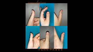 Brachydactyly Type D distraction lengthening brachydactyly doctor thumb meganfox [upl. by Gordan]