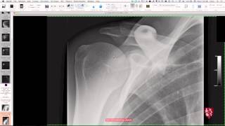 Upper Extremity Case Conference Shoulder Girdle [upl. by Franek876]