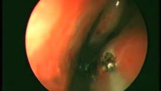 Reducción de cornetes inferiores con láser diodo de 980nm  Inferior turbinates with 980nm diode l [upl. by Ozan]