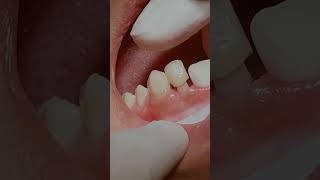 Zirconia crowns dentistry [upl. by Ysus92]