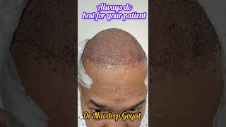 Always do best hair transplant for your patients Dr Navdeep hair transplant Laser 919416500112 [upl. by Dona]