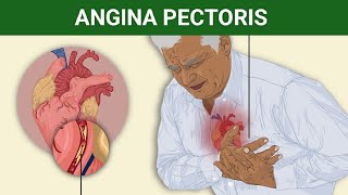 Angina pectoris EtiologyClinical FeaturesPathophysiologyMedical Management  Complication [upl. by Ecnarrot]