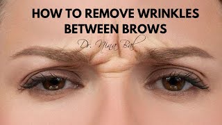 How To Get Rid Of Wrinkles Between Eyebrows 💕 Dr Nina Bal Glabellar Lines Removal [upl. by Nonac]