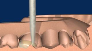 Provisorische Brücke mit Structur 3  Einfach ästhetisch stabil [upl. by Sherl6]