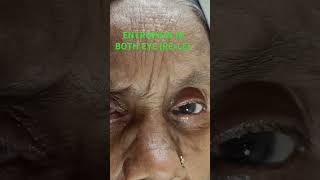 ENTROPION CASEOPHTHALMOLOGY PATIENT ENTROPIONCLINICAL CASE ENTROPIONEYELASHES PROBLEM [upl. by Sheryl]