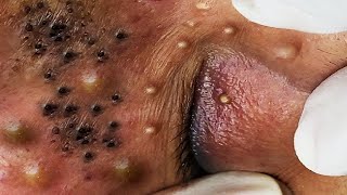 BLACKHEAD PIMPLES REMOVAL OF THE ELDERLY IN CAN THO  243 [upl. by Aimee]