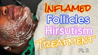 Inflamed Follicles Hirsutism Treatment Skincare wextractions pt 2 FOLLOWUP [upl. by Philip650]