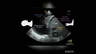 Pleural effusion on Ultrasound POCUS [upl. by Anitsugua]