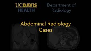 Medullary nephrocalcinosis on ultrasound [upl. by Erbe]