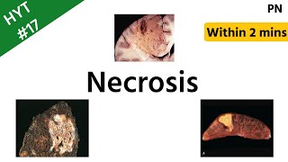 Necrosis  Types of Necrosis  Pathology  HYT 17  NEETPG  INICET [upl. by Walczak]