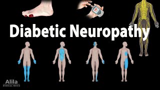 Diabetic Neuropathy Animation [upl. by Llednar128]