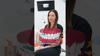 Can Invisalign fix a crossbite dentalexperts drjoydentalclinic yourdentist [upl. by Urson]