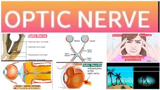 Optic Nerve 2Major Papilloedema 1 [upl. by Eimmij]